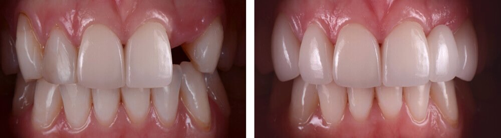Dental Implants example in Rochdale