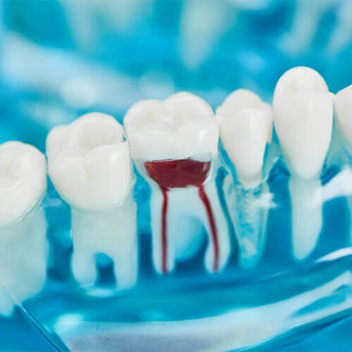 Root Canal Treatment in Rochdale